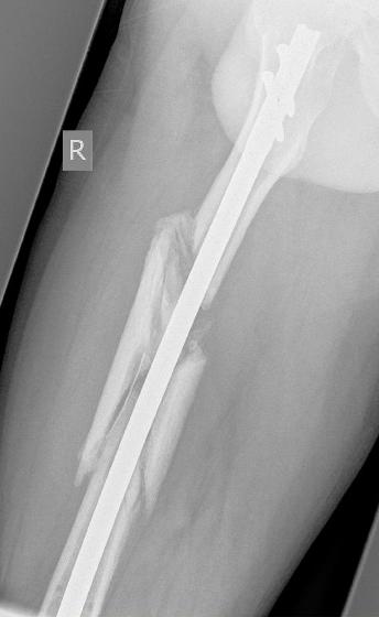 My newly growing femur