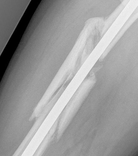 Improving femur